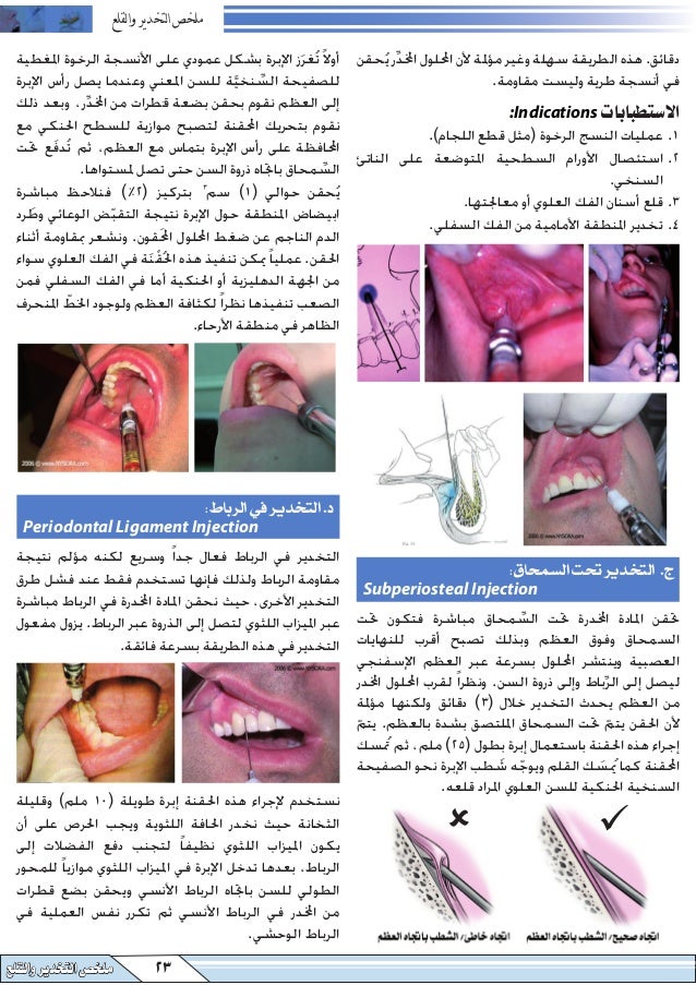 المرشد العلمي في التخدير والقلع