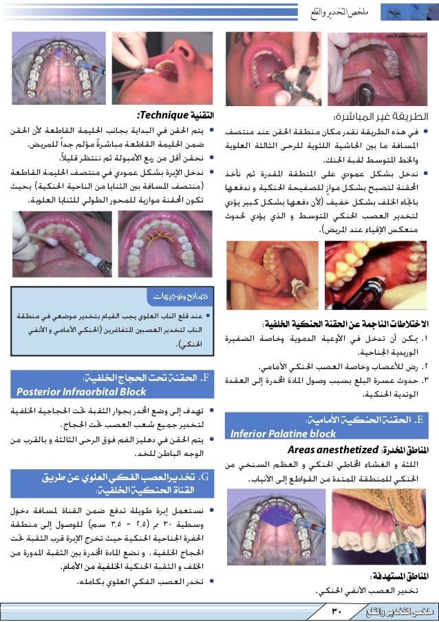 المرشد العلمي في التخدير والقلع