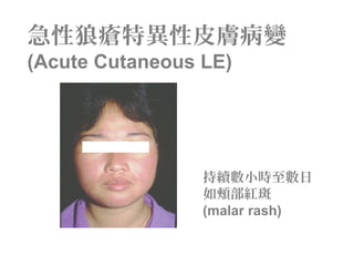 持續數小時至數日
如頰部紅斑
(malar rash)
急性狼瘡特異性皮膚病變
(Acute Cutaneous LE)
 