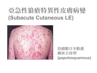 亞急性狼瘡特異性皮膚病變
(Subacute Cutaneous LE)
持續數日至數週
鱗 丘疹型狀
(papulosquamous)
 