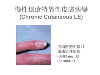慢性狼瘡特異性皮膚病變
(Chronic Cutaneous LE)
持續數週至數月
如凍瘡性狼瘡
(chilblains LE)
(perniotic LE)
 