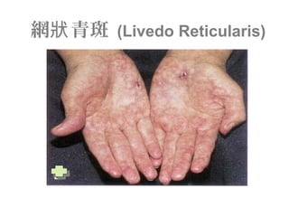 網 青斑狀 (Livedo Reticularis)
 