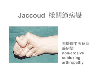Jaccoud 樣關節病變
無糜爛半 位關脫
節病變
non-erosive
subluxing
arthropathy
 