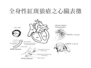 全身性紅斑狼瘡之心臟表徵
 