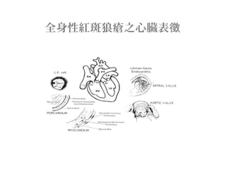 全身性紅斑狼瘡之心臟表徵
 