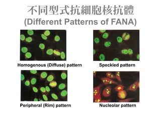 不同型式抗細胞核抗體
(Different Patterns of FANA)
Homogenous (Diffuse) pattern Speckled pattern
Peripheral (Rim) pattern Nucleolar pattern
 