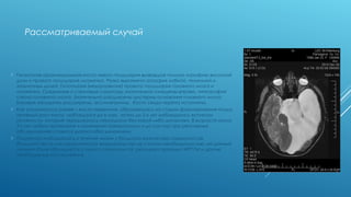РАССМАТРИВАЕМЫЙ СЛУЧАЙ
 Гигантская арахноидальная киста левого полушария вызвавшая полную атрофию
височной доли и правого полушария мозжечка. Резко выражена атрофия лобной,
теменной и затылочных долей. Гипоплазия (недоразвитие) правого полушария головного
мозга и мозжечка. Срединные и стволовые структуры значительно смещены вправо,
гипотрофия ствола головного мозга. Значительно расширены цистерны основания
головного мозга. Боковые желудочки расширены, ассиметричны. Кости свода черепа
истончены.
 Как упоминалось ранее – киста первичная, образовалась на стадии формирования
плода, активный рост кисты наблюдался до 6 мес, затем до 2-х лет наблюдались
всплески активности, которые чередовались периодами «затишья». В возрасте около 2-х
лет любые проявления и изменения прекратились и до сих пор при регулярных
обследованиях ставится диагноз «без динамики».
 Пациентка наблюдалась в течение жизни у большого количества специалистов,
большинство из них хирургическое вмешательство не считали необходимостью, на
данный момент пациентка регулярно проходит МРТ ГМ и другие необходимые
исследования.
 