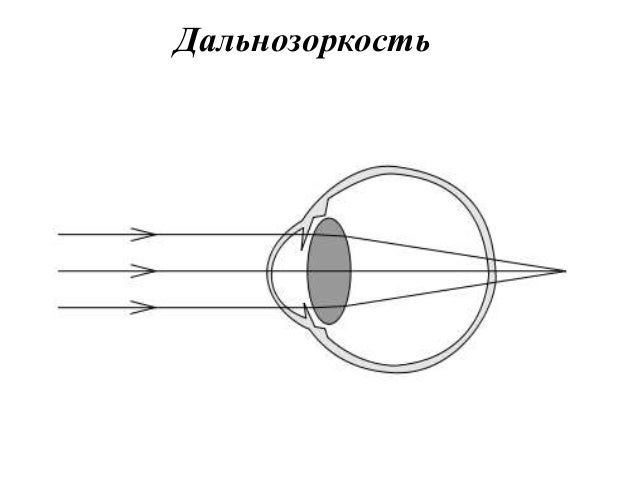 этапы проведения гониоскопии.