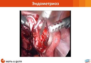 Эндометриоз
 