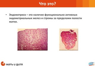 • Эндометриоз – это наличие функционально активных
эндометриальных желез и стромы за пределами полости
матки.
Что это?
 