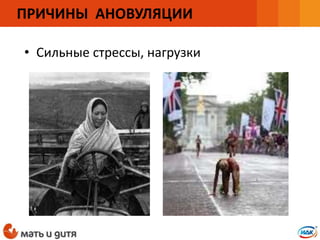 • Сильные стрессы, нагрузки
ПРИЧИНЫ АНОВУЛЯЦИИ
 