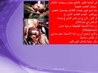 ‫طه‬ ‫محمد‬ ‫العباقره‬ ‫بعقول‬ ‫فكر‬
‫ويحدث‬ ‫مبشره‬ ‫النتائج‬ ‫تظهر‬ ‫البداية‬ ‫فى‬‫االلتئام‬
‫طبيعيا‬ ‫العضو‬ ‫ويعمل‬
‫ا‬ ‫يضمحل‬ ‫التفاعل‬ ‫يحدث‬ ‫أسبوعيين‬ ‫بعد‬‫لعضو‬
‫المنزرع‬ ‫العضو‬ ‫الجسم‬ ‫ويرفض‬
‫يحدث‬ ‫المتبرع‬ ‫نفس‬ ‫من‬ ‫الزرع‬ ‫تكرر‬ ‫لو‬
‫قالئل‬ ‫أيام‬ ‫في‬ ‫الرفض‬
‫مدوار‬ ‫درسها‬ ‫الطبيعية‬ ‫األنسجة‬ ‫زراعة‬
Medawar))
‫مناعي‬ ‫عمل‬ ‫األنسجة‬ ‫زراعة‬ ‫أن‬ ‫أوضح‬ ‫والذي‬
‫مناعية‬ ‫ظاهره‬ ‫أو‬
‫التيبركلين‬ ‫تفاعل‬ ‫عملية‬ ‫مثل‬
 