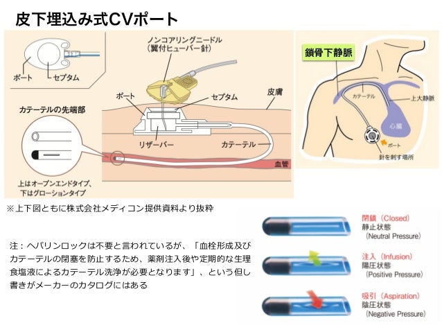 Cvポート ヘパリンロック 間隔 , 中心静脈ポート …