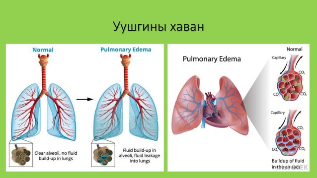 уушиг тогших үзлэг | PPT