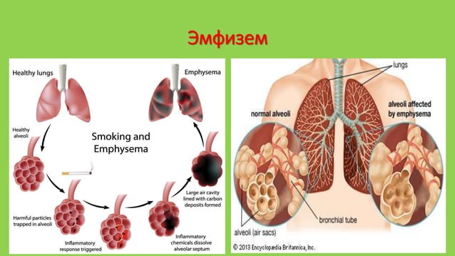 уушиг тогших үзлэг | PPT
