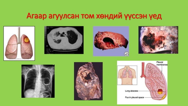 уушиг тогших үзлэг | PPT