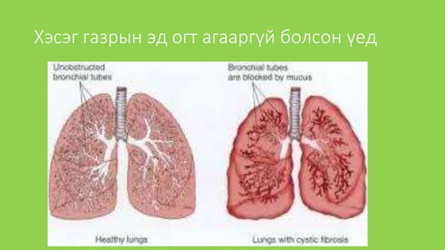 уушиг тогших үзлэг | PPT
