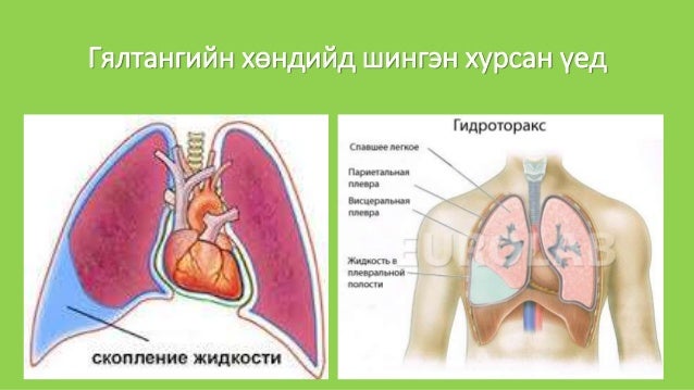 уушиг тогших үзлэг