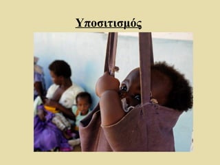 Υποσιτισμός
 