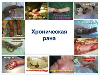 Современные Подходы К Лечению Хронических Ран И Пролежней | PPT