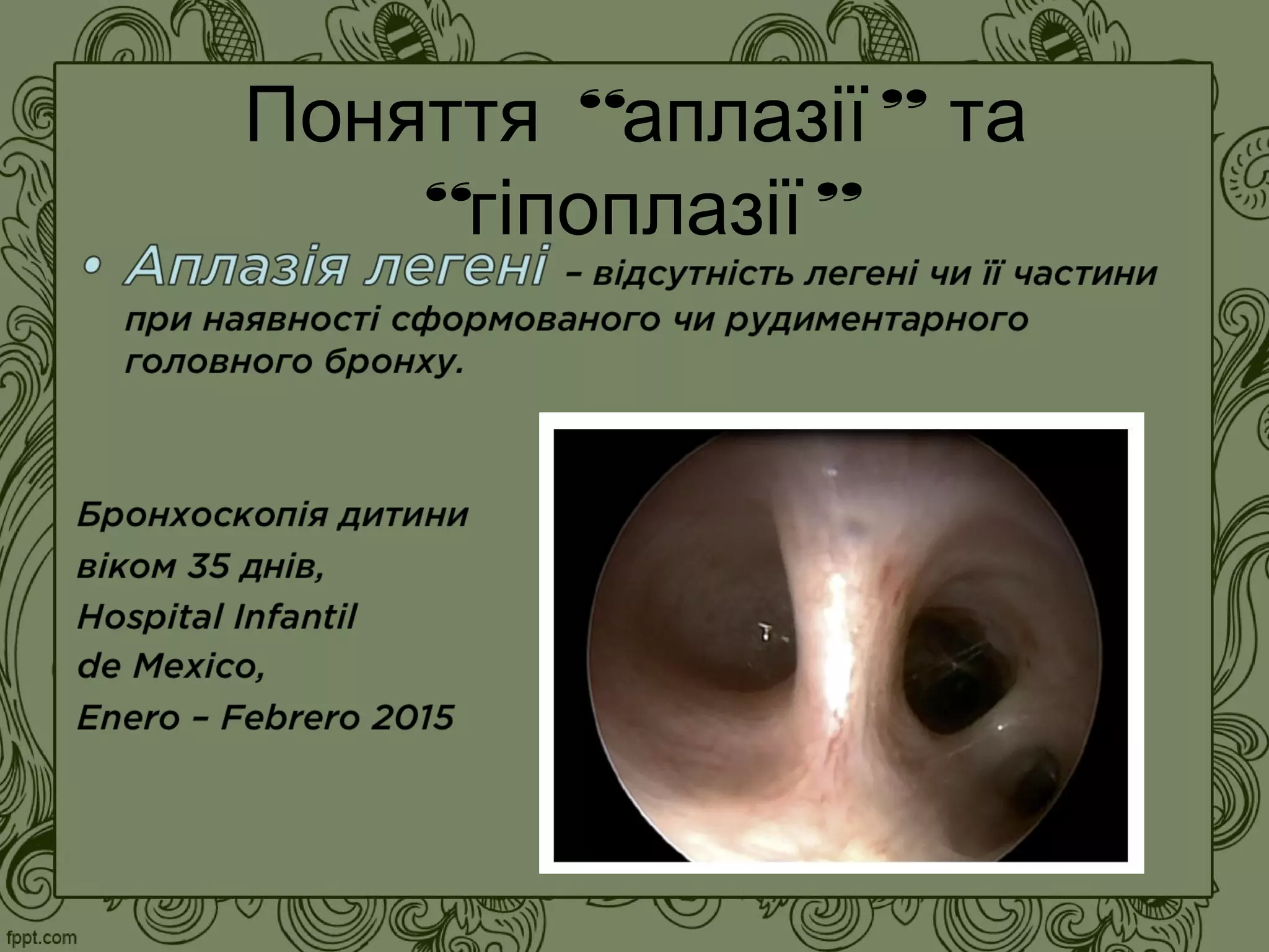 “ ”Поняття аплазії та
“ ”гіпоплазії
 