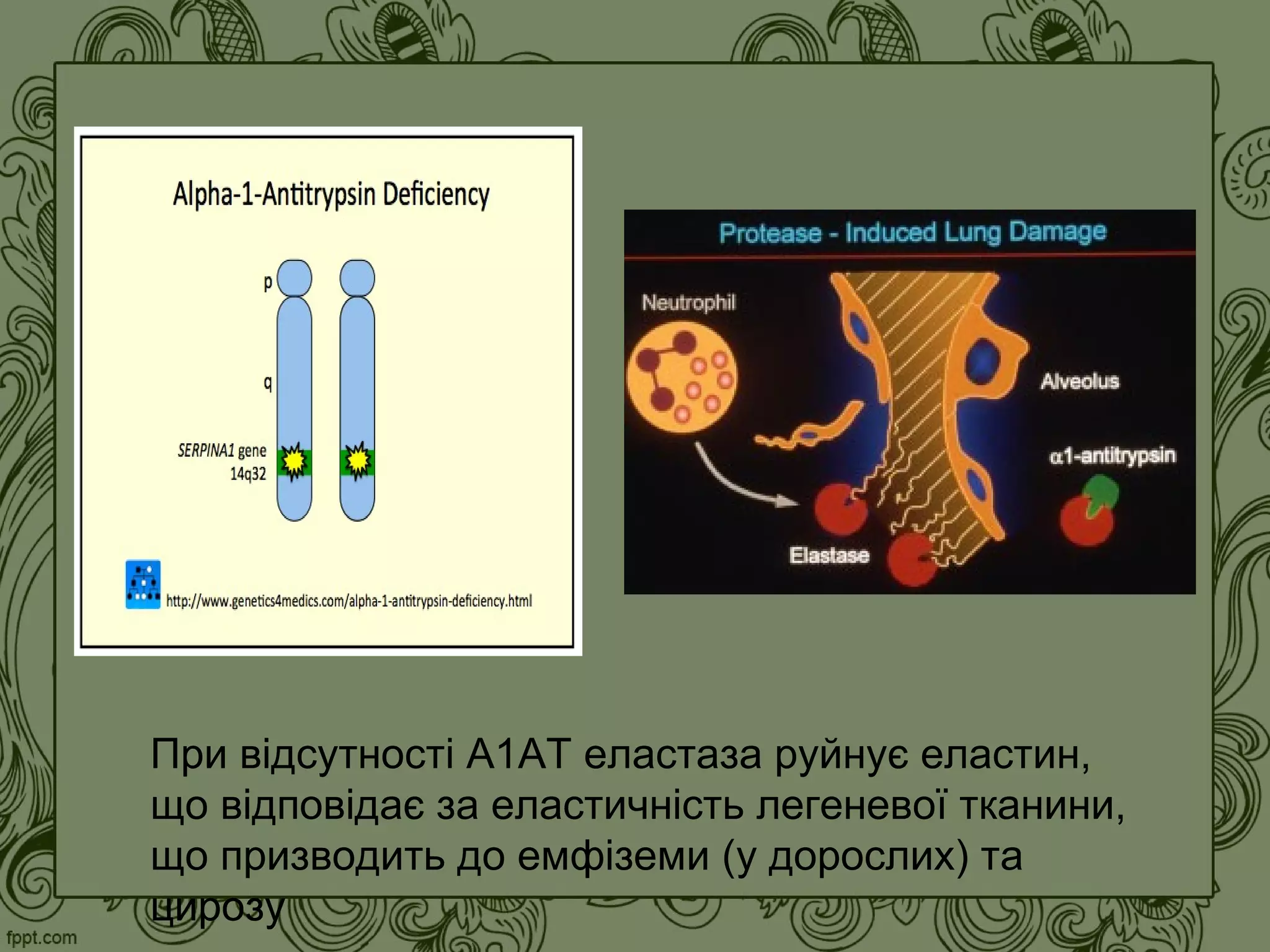 При відсутності А1АТ еластаза руйнує еластин,
що відповідає за еластичність легеневої тканини,
що призводить до емфіземи (у дорослих) та
цирозу
 