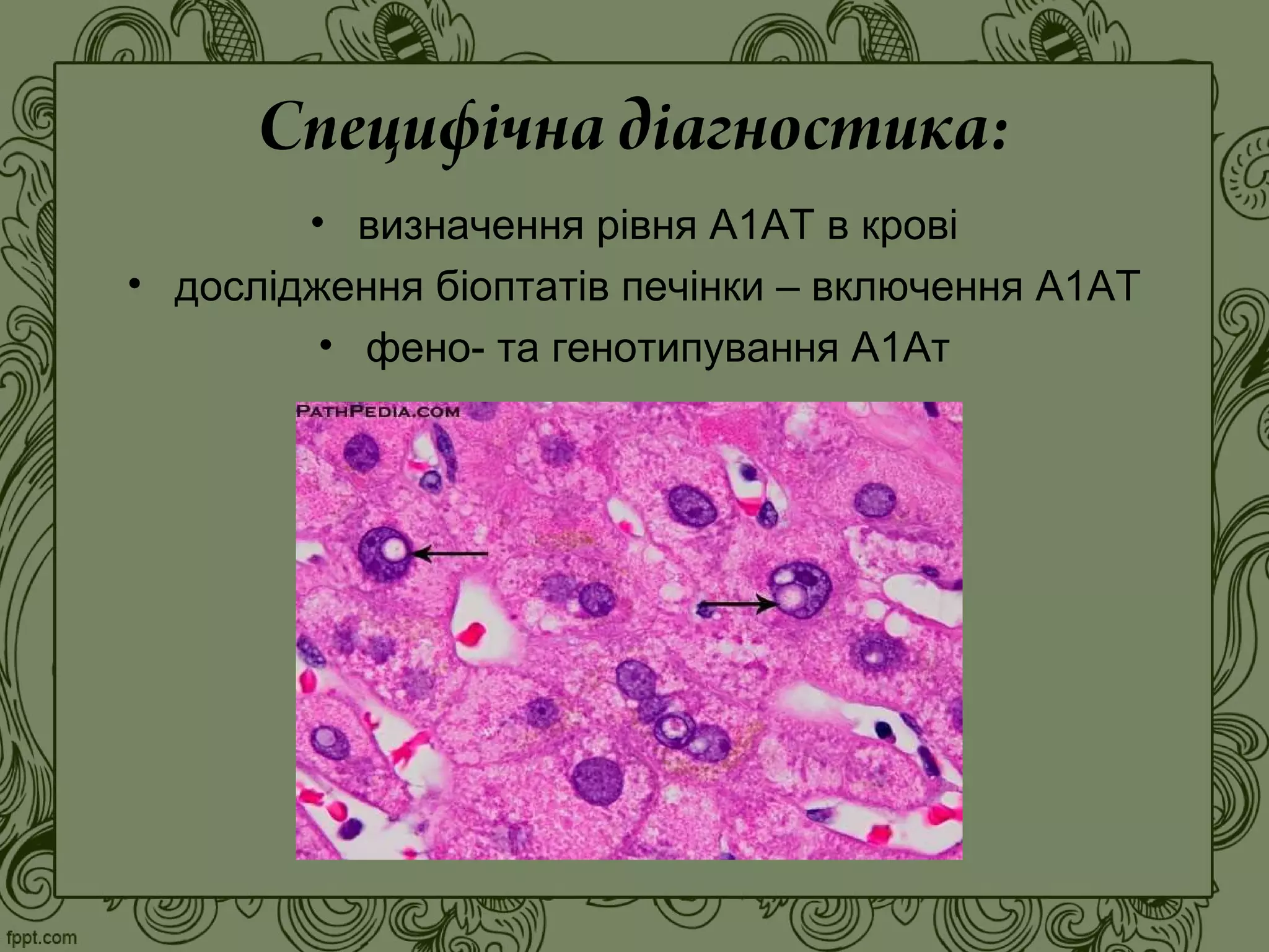 Специфічна діагностика:
• визначення рівня А1АТ в крові
• дослідження біоптатів печінки – включення А1АТ
• фено- та генотипування А1Ат
 