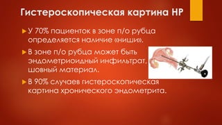 Гистероскопическая картина НР
 У 70% пациенток в зоне п/о рубца
определяется наличие «ниши».
 В зоне п/о рубца может быть
эндометриоидный инфильтрат,
шовный материал.
 В 90% случаев гистероскопическая
картина хронического эндометрита.
 