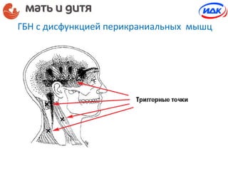 ГБН с дисфункцией перикраниальных мышц
 