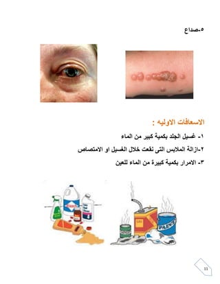 11
5-‫صداع‬
: ‫االولٌه‬ ‫االسعافات‬
0-‫الماء‬ ‫من‬ ‫كبٌر‬ ‫بكمٌة‬ ‫الجلد‬ ‫ؼسٌل‬
5-‫االمتصاص‬ ‫او‬ ‫الؽسٌل‬ ‫خالل‬ ‫نمعت‬ ‫التى‬ ‫المالبس‬ ‫ازالة‬
3-‫الماء‬ ‫من‬ ‫كبٌرة‬ ‫بكمٌة‬ ‫االمرار‬‫للعٌن‬
 