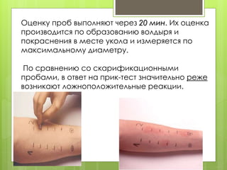 Оценку проб выполняют через 20 мин. Их оценка
производится по образованию волдыря и
покраснения в месте укола и измеряется по
максимальному диаметру.
По сравнению со скарификационными
пробами, в ответ на прик-тест значительно реже
возникают ложноположительные реакции.
 