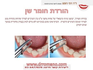 ‫הצורך‬ ‫במידת‬,‫מ‬ ‫מחצי‬ ‫פחות‬ ‫של‬ ‫מינמאלי‬ ‫שיוף‬ ‫יבוצע‬"‫מגע‬ ‫נקודות‬ ‫פתיחת‬ ‫לצורך‬ ‫השיניים‬ ‫בין‬ ‫מ‬
‫הרצויה‬ ‫השיניים‬ ‫תנועת‬ ‫לצורך‬.‫לנזק‬ ‫גורם‬ ‫ולא‬ ‫בשיניים‬ ‫פוגע‬ ‫אינו‬ ‫השיוף‬(‫במשך‬ ‫מחקרית‬ ‫נבדק‬
‫רבות‬ ‫שנים‬)
 