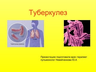 Туберкулез
Презентацию подготовила врач терапевт
пульмонолог Невейченкова Ю.А
 