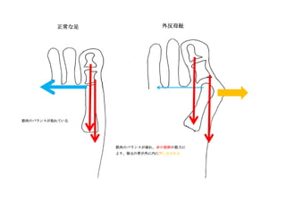 正常な足
筋肉のバランスが取れている
外反母趾
筋肉のバランスが崩れ、赤の筋群の筋力に
より、根元の骨が外に内に押し出される
 