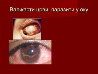 Ваљкасти црви, паразити у окуВаљкасти црви, паразити у оку
 