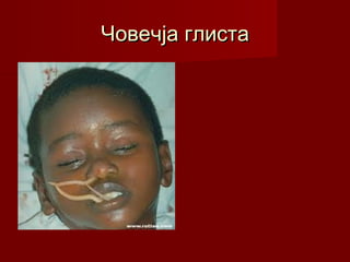 Човечја глистаЧовечја глиста
 