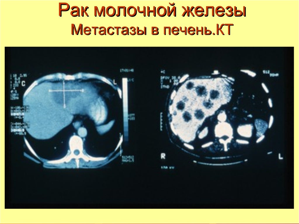 Рак молочной железы метастазы лечение. Гиповаскулярные метастазы печени кт. Опухоль молочной железы на кт. Метастазы молочной железы кт.