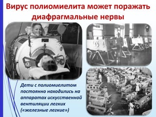 Вирус полиомиелита может поражать
диафрагмальные нервы
Дети с полиомиелитом
постоянно находились на
аппаратах искусственной
вентиляции легких
(«железные легкие»)
 