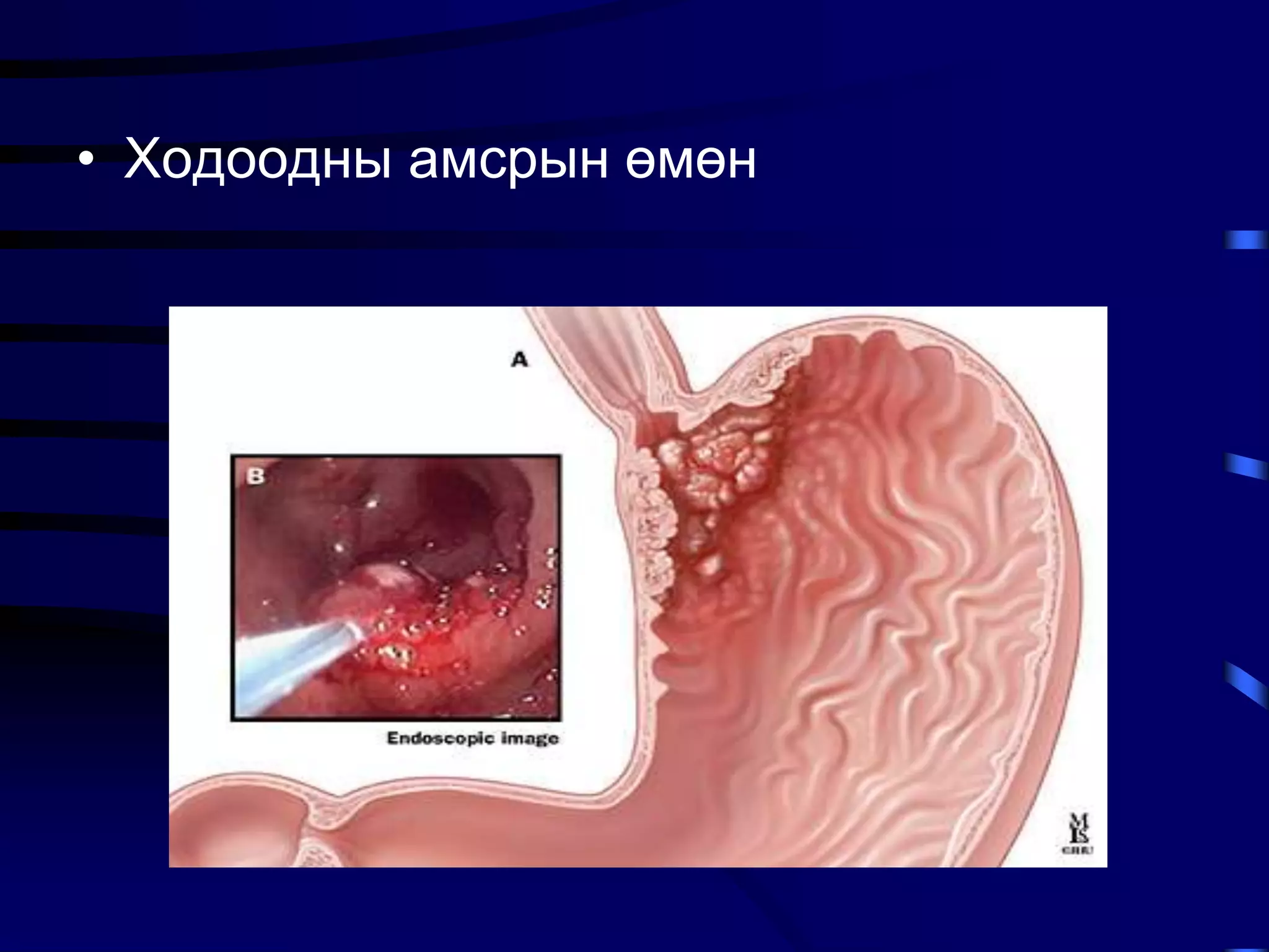 Ходоодны хорт хавдар | PPT