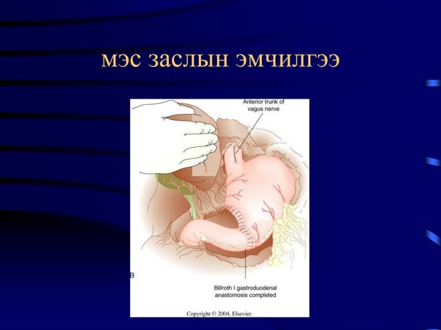 Ходоодны хорт хавдар | PPT
