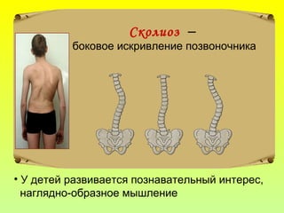 Сколиоз –
боковое искривление позвоночника
• У детей развивается познавательный интерес,
наглядно-образное мышление
 
