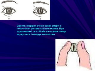 Одним з перших очних ознак смерті є
помутніння рогівки та її висихання. При
здавлюванні ока з боків пальцями зіниця
звужується і нагадує котяче око.
 
