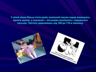 У дітей віком більш п'яти років зовнішній масаж серця виконують
однією рукою, у немовлят - кінчиками вказівного і середнього
пальців. Частота здавлювань від 100 до 110 в хвилину.
 