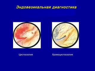 Эндовезикальная диагностикаЭндовезикальная диагностика
Цистоскопия ХромоцистоскопияЦистоскопия Хромоцистоскопия
 