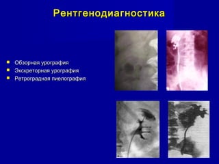 РентгенодиагностикаРентгенодиагностика
 Обзорная урографияОбзорная урография
 Экскреторная урографияЭкскреторная урография
 Ретроградная пиелографияРетроградная пиелография
 