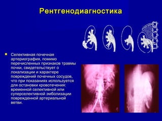 РентгенодиагностикаРентгенодиагностика
 Селективная почечнаяСелективная почечная
артериография, помимоартериография, помимо
перечисленных признаков травмыперечисленных признаков травмы
почки, свидетельствует опочки, свидетельствует о
локализации и характерелокализации и характере
повреждений почечных сосудов,повреждений почечных сосудов,
что при показаниях используетсячто при показаниях используется
для остановки кровотечения:для остановки кровотечения:
временной селективной иливременной селективной или
суперселективной эмболизациисуперселективной эмболизации
поврежденной артериальнойповрежденной артериальной
ветви.ветви.
 