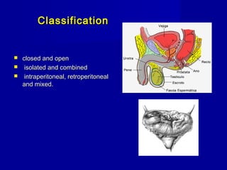 ClassificationClassification
 closed and openclosed and open
 isolated and combinedisolated and combined
 intraperitoneal, retroperitonealintraperitoneal, retroperitoneal
and mixed.and mixed.
 
