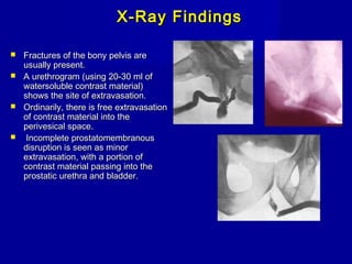 X-Ray FindingsX-Ray Findings
 Fractures of the bony pelvis areFractures of the bony pelvis are
usually present.usually present.
 A urethrogram (using 20-30 ml ofA urethrogram (using 20-30 ml of
watersoluble contrast material)watersoluble contrast material)
shows the site of extravasation.shows the site of extravasation.
 Ordinarily, there is free extravasationOrdinarily, there is free extravasation
of contrast material into theof contrast material into the
perivesical space.perivesical space.
 Incomplete prostatomembranousIncomplete prostatomembranous
disruption is seen as minordisruption is seen as minor
extravasation, with a portion ofextravasation, with a portion of
contrast material passing into thecontrast material passing into the
prostatic urethra and bladder.prostatic urethra and bladder.
 