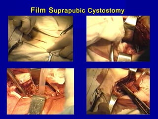 Film SFilm Suprapubic Cystostomyuprapubic Cystostomy
 