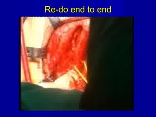 Re-do end to endRe-do end to end
 